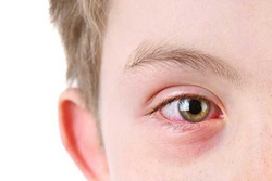 علائم هشدار بیماری چشم در کودکان