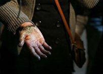 وقوع سالانه 300هزار مورد سوختگی/ تخت سوختگی استاندارد دولتی نداریم