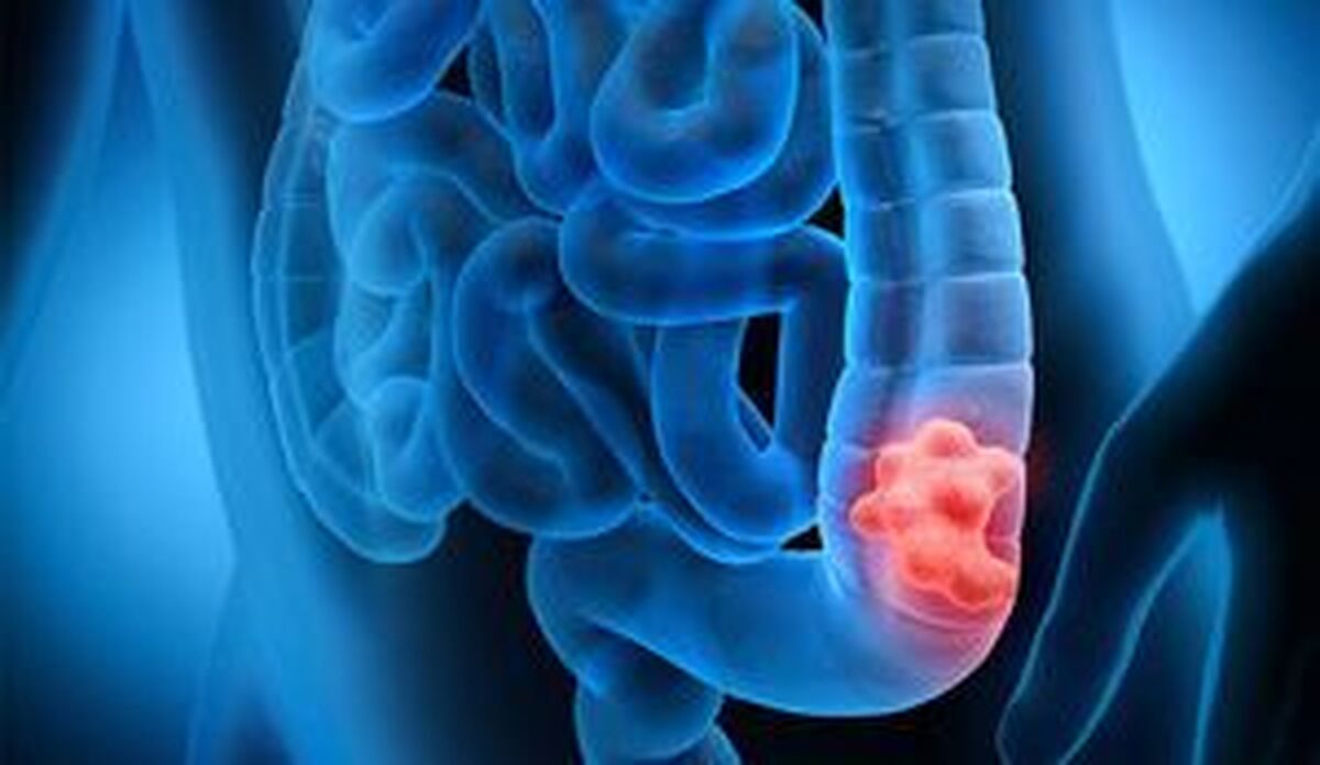 مصرف مشروبات الکلی خطر ابتلا به سرطان روده بزرگ را افزایش می‌دهد