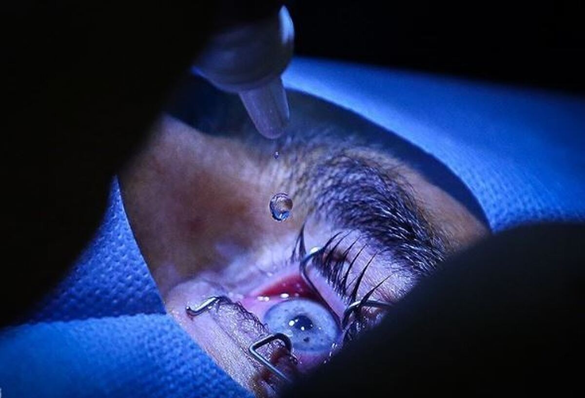 شیوع قوز قرنیه در ایران بالاتر از جهان/چه عواملی باعث بروز بیماری می‌شود؟