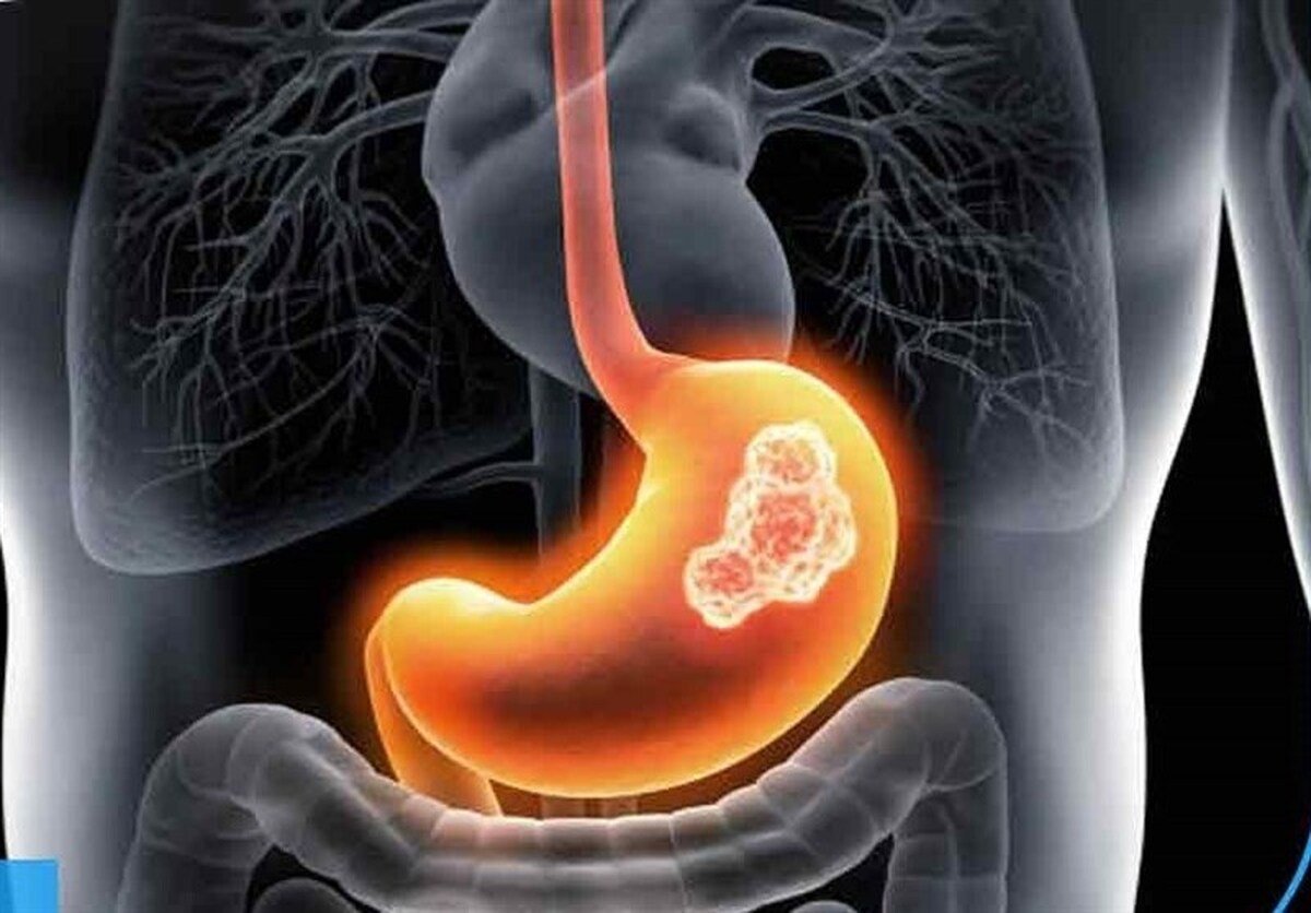سرطان‌‌های معده و روده بزرگ شایع‌ترین انواع سرطان
